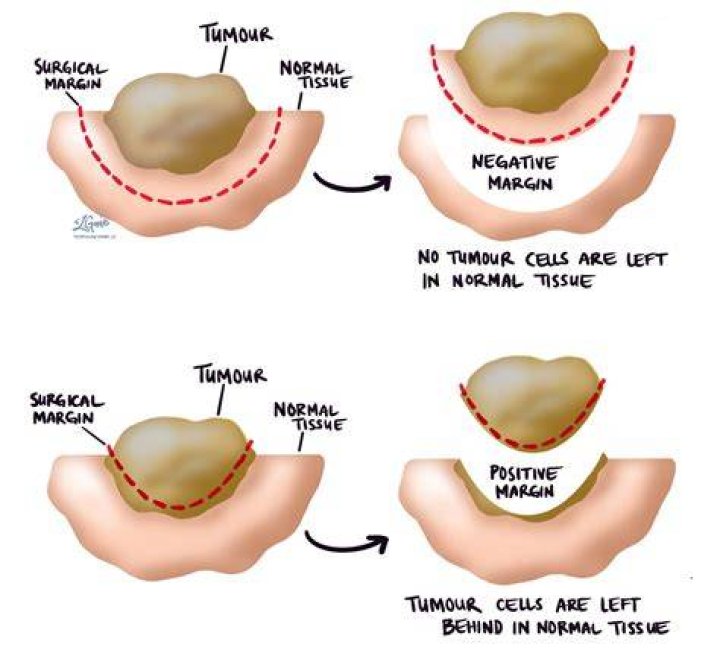 Are phyllodes tumors curable