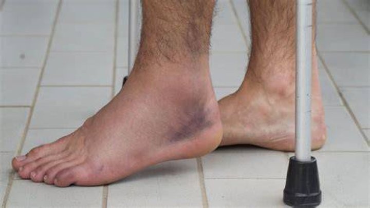 Can a rolled ankle be broken