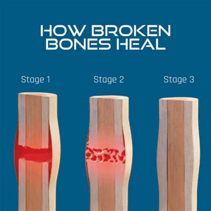Can Arnica help broken bones