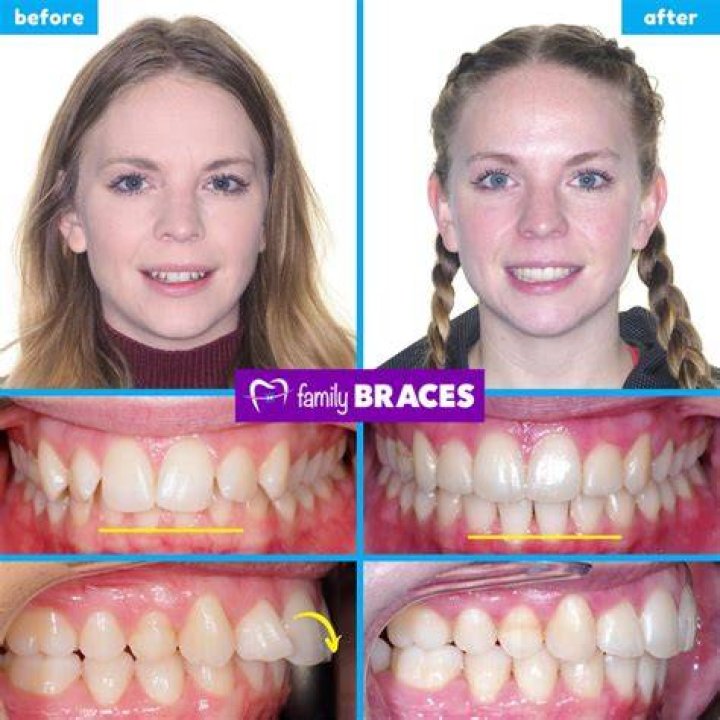 Can braces mess up your bite