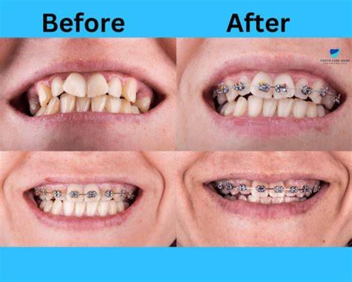 Can braces push my teeth out