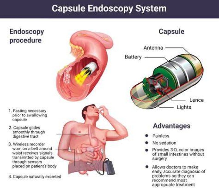 Can capsule endoscopy replace colonoscopy