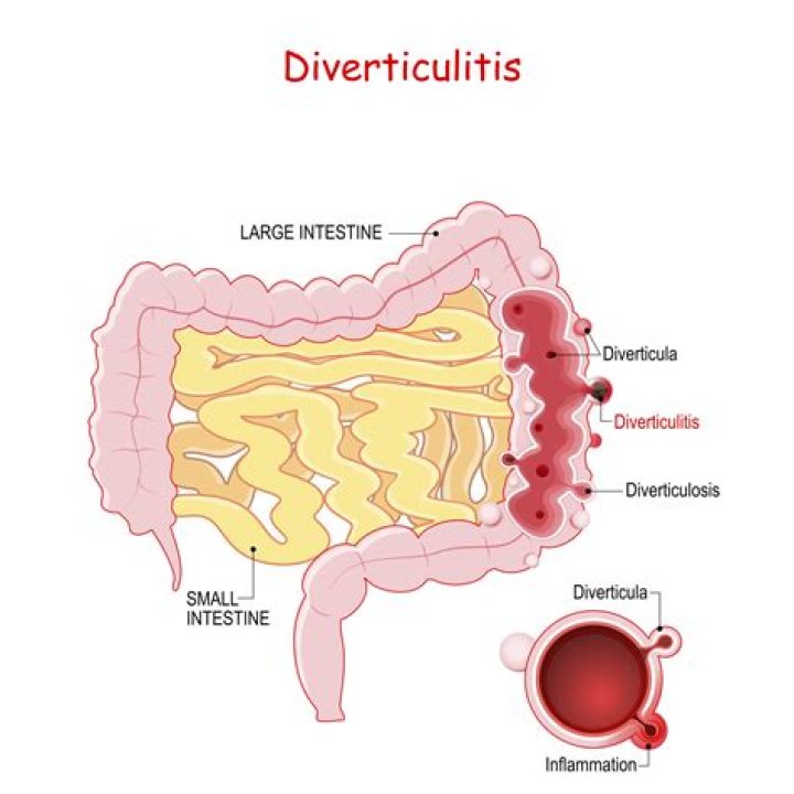 Can diverticula be reversed