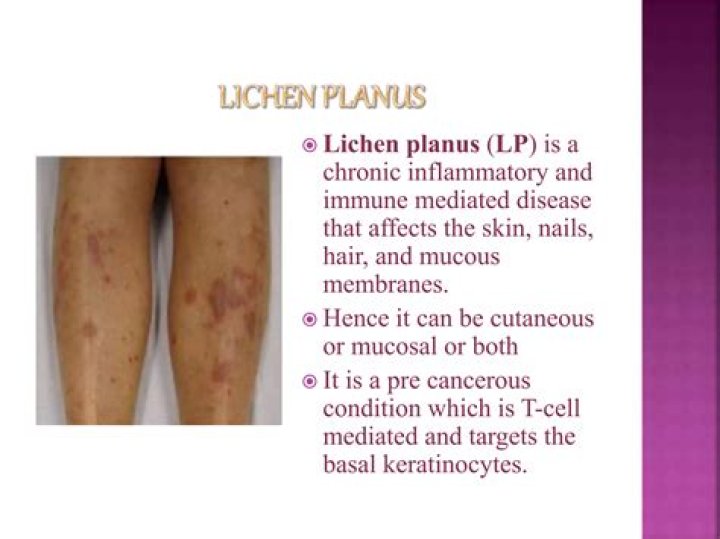 Can pes planus be corrected