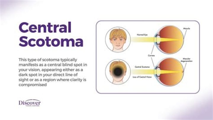 Can scotoma cause blindness