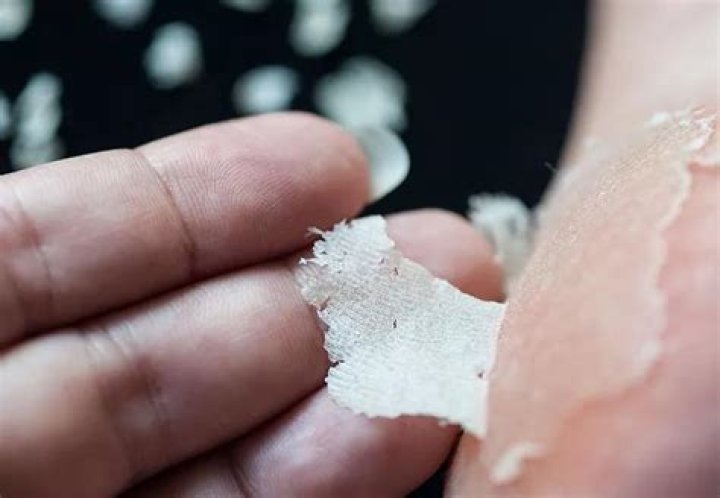 Do foot peels actually work