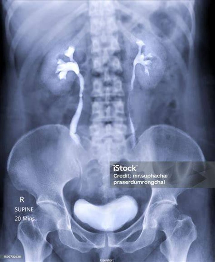 Does CT Urogram show ovaries