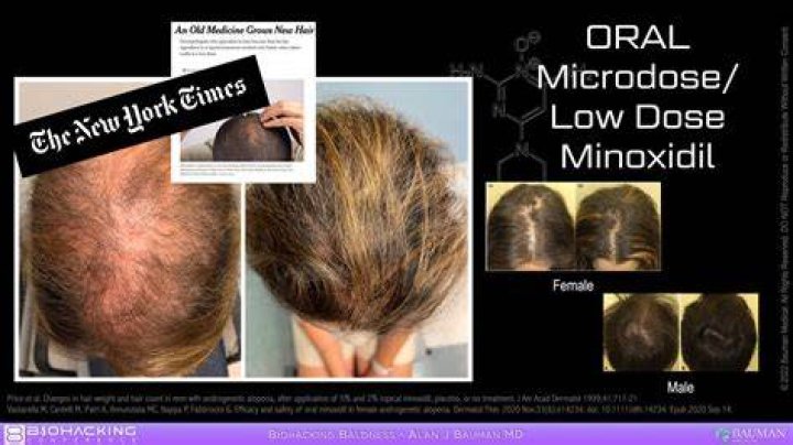 Does minoxidil age your face
