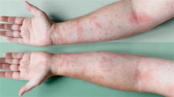 Does Photodermatitis go away