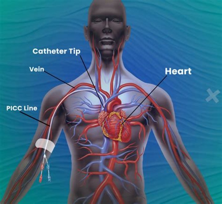 Does PICC line need consent