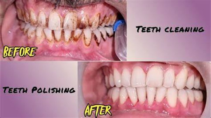 Does polishing damage teeth