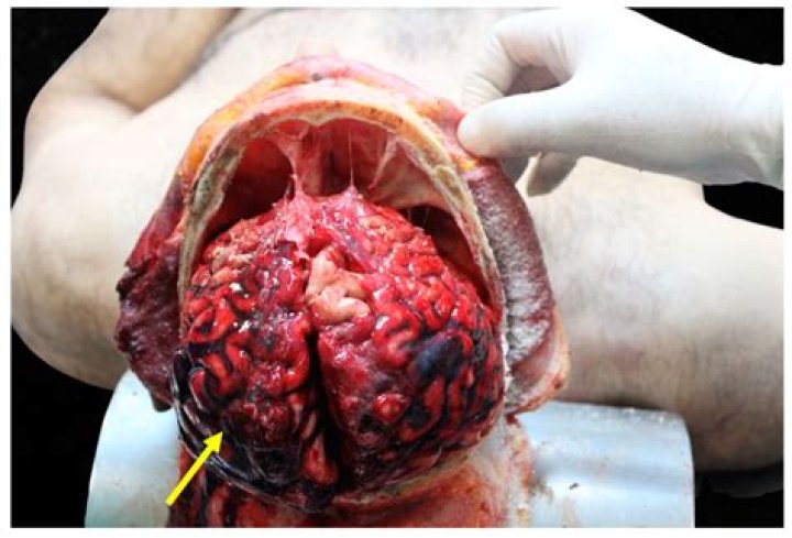 Does SIDS show up on autopsy
