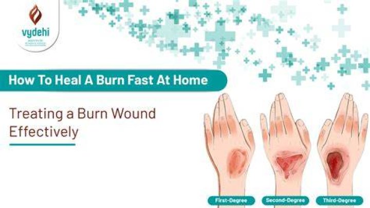 How do I heal a burn quickly