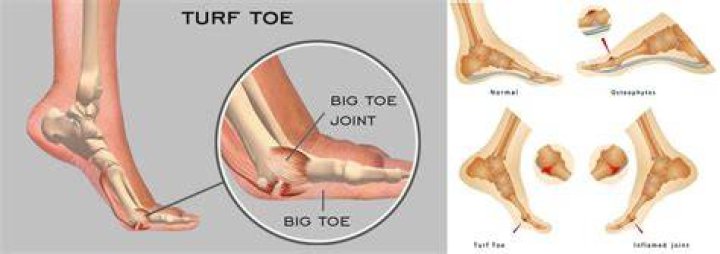 How do you diagnose turf toe