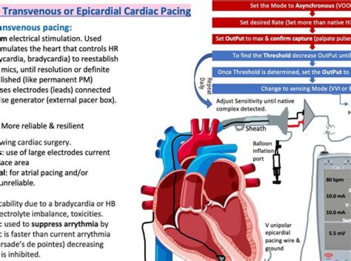 How does cardiac pacing work