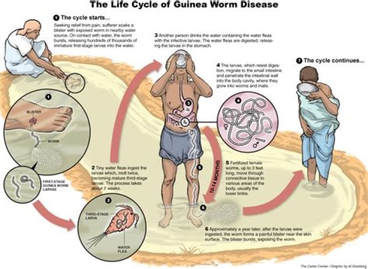 How is guinea worm diagnosed