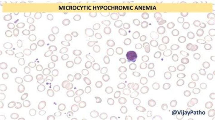 How is Microcytosis treated