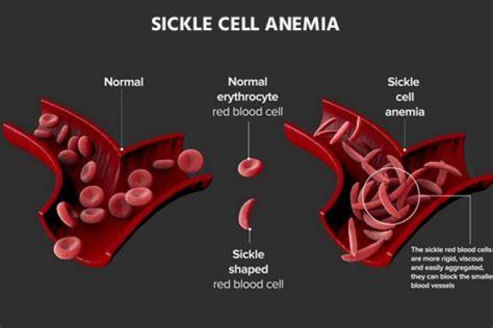 How is sickle cell anemia prevented