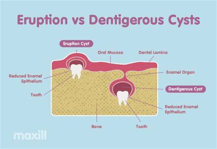 How long do eruption cysts last