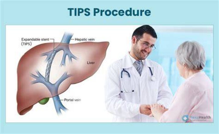 How long does a TIPS procedure take