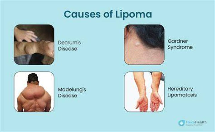 Is a lipoma dangerous