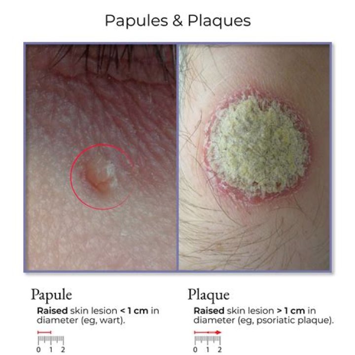 Is a papule a primary lesion