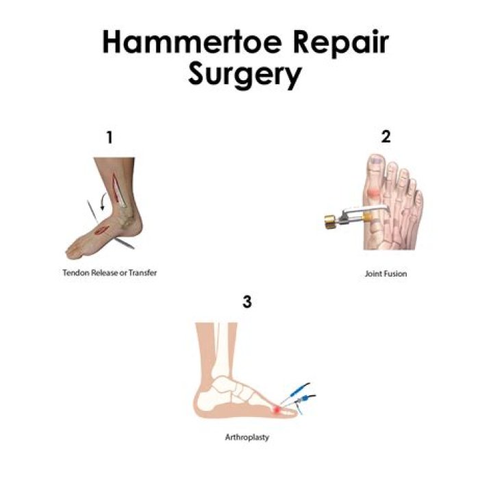Is hammertoe surgery painful
