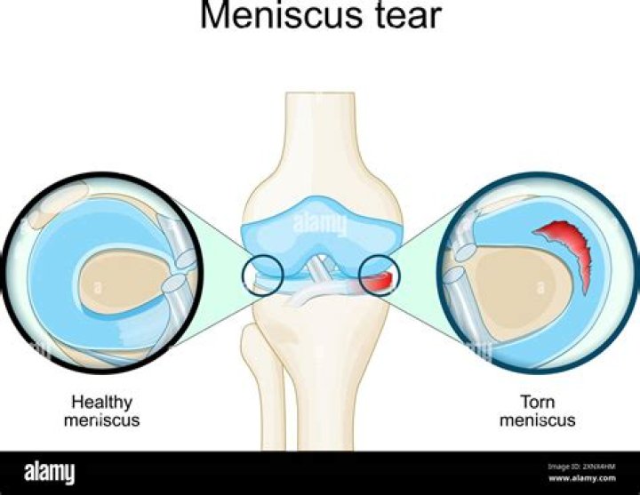 Is meniscus tissue avascular