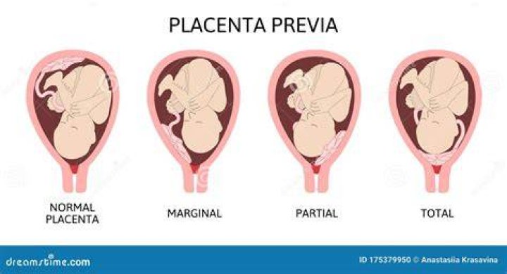 Is posterior placenta normal