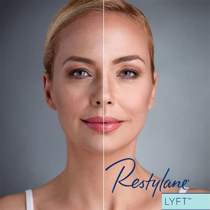 Is Restylane LYFT permanent