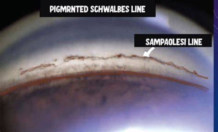 Is Schwalbes line pigmented
