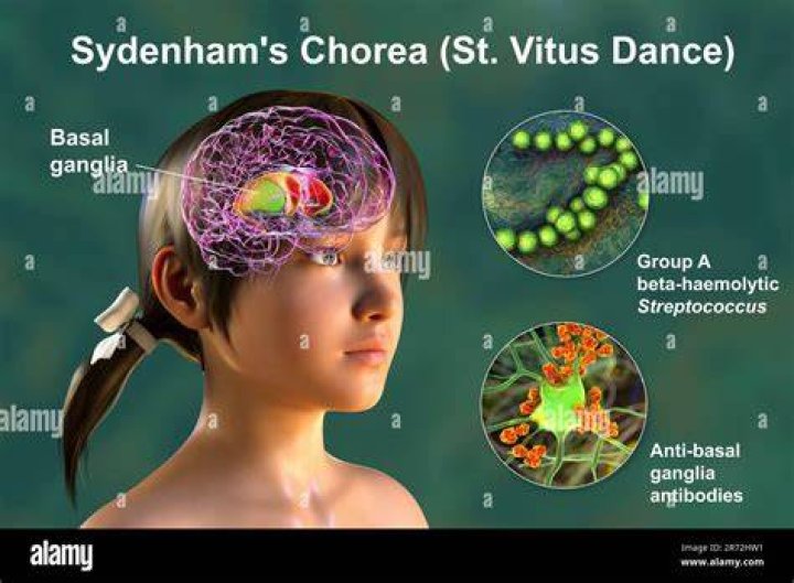 Is Sydenham chorea permanent