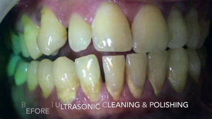 Is tooth polishing necessary