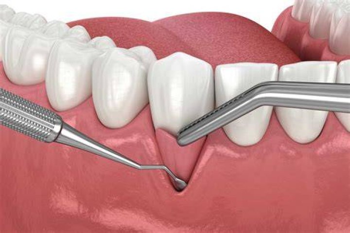 ¿Qué es la encia interdental