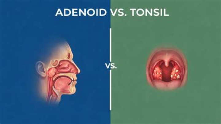 What are adenoids vs tonsils