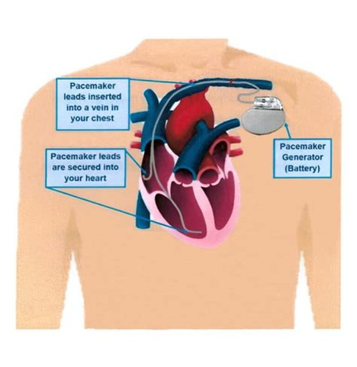 What are internal pacemakers