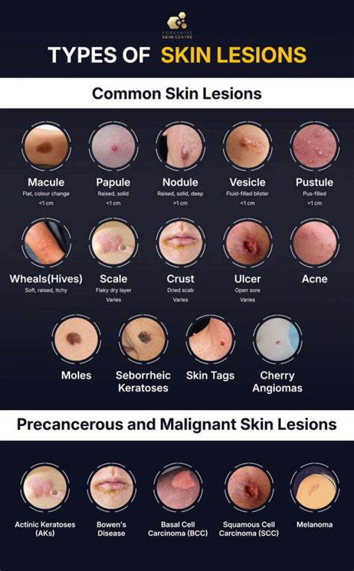 What causes a target lesion
