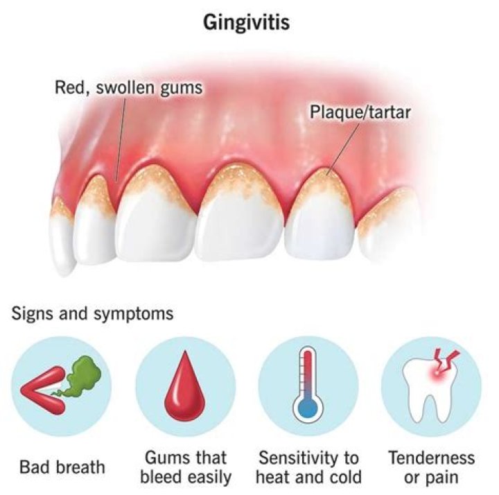 What causes acute gingivitis