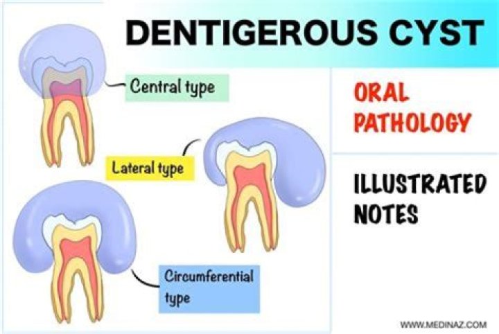What causes dentigerous cyst