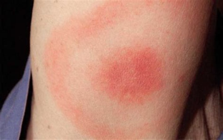 What causes erythema migrans