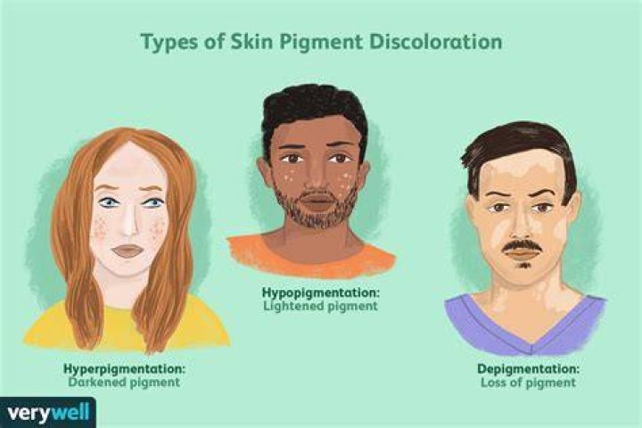 What causes pigment disorder