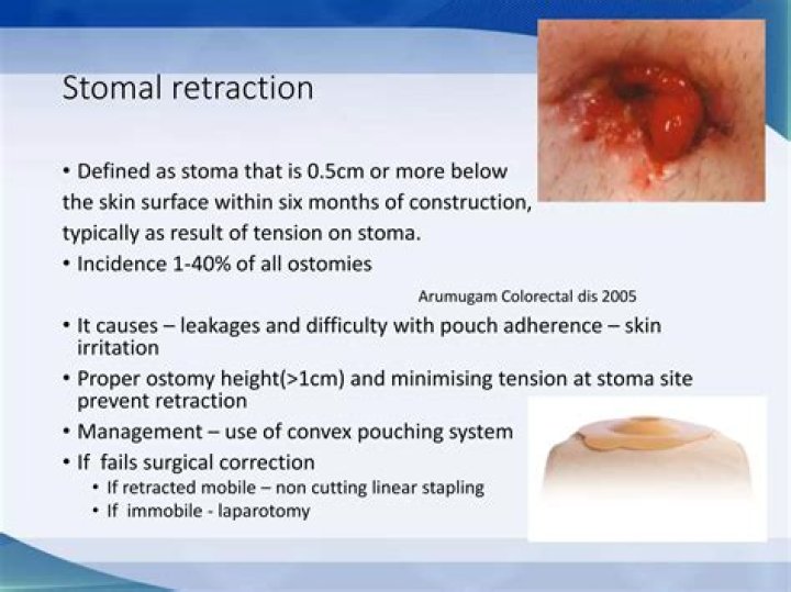 What causes stoma retraction