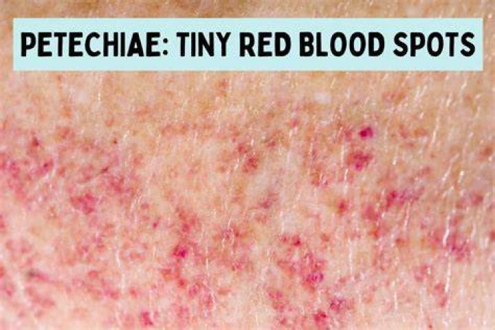 What does a petechial rash look like