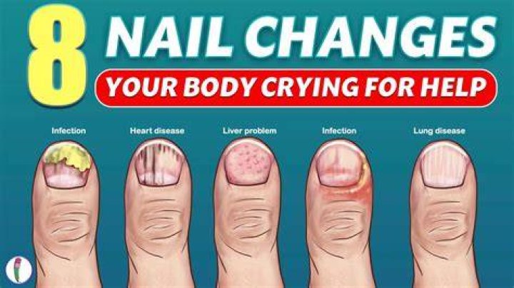 What does anemia do to nails