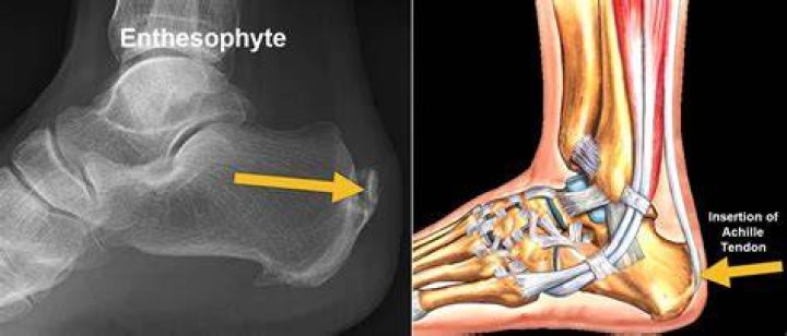 What does Enthesophytes mean