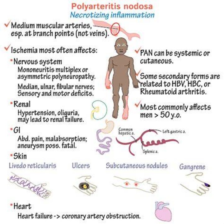 What does polyarteritis mean