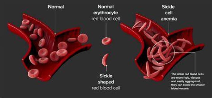 What does sickle cell effect