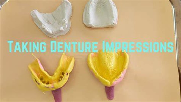 What is a denture impression