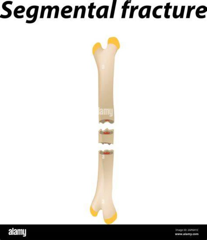 What is a segmental fracture