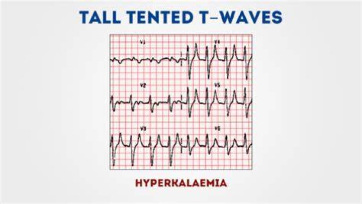 What is a tall tented T wave